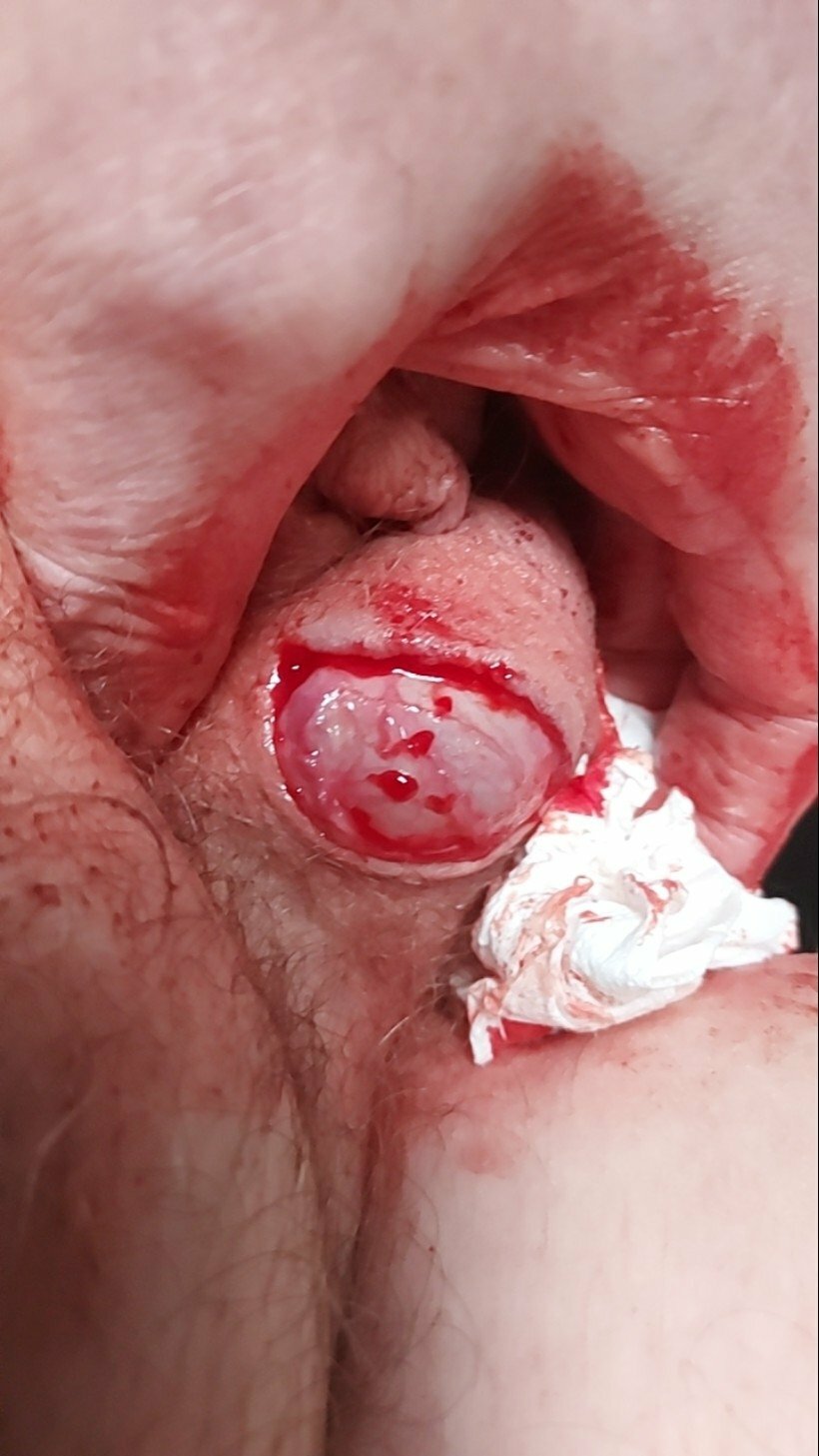 brumeato / scrotum cut open