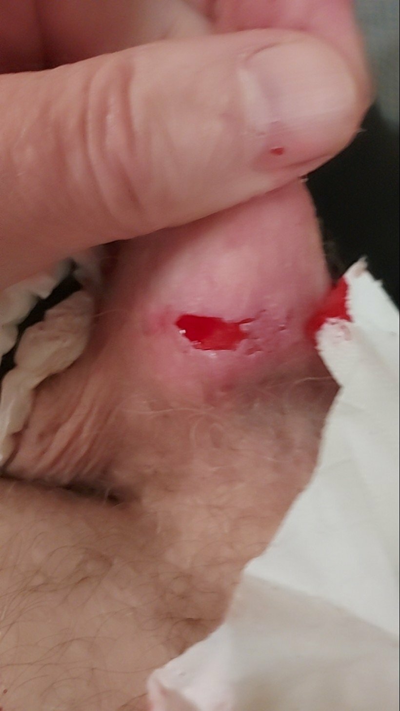 brumeato / scrotum cut open