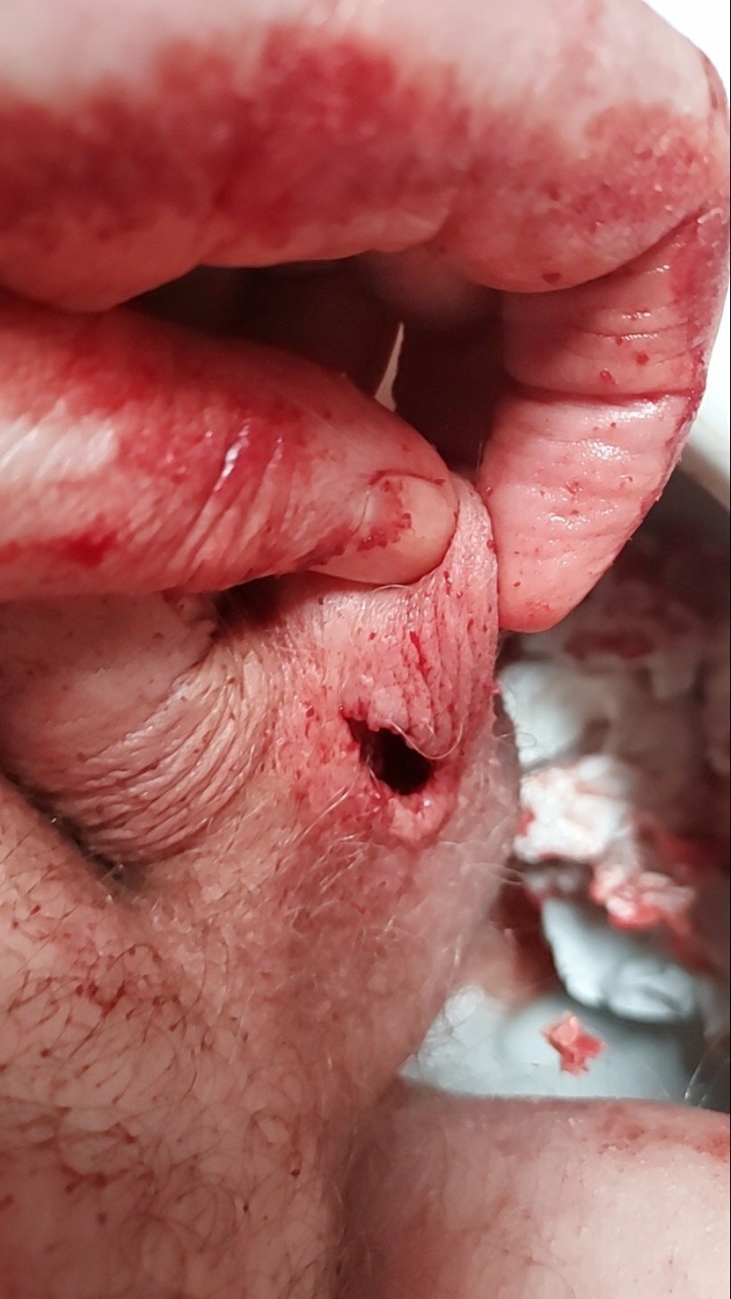 brumeato / scrotum cut open