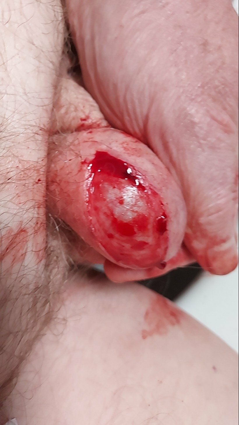brumeato / scrotum cut open
