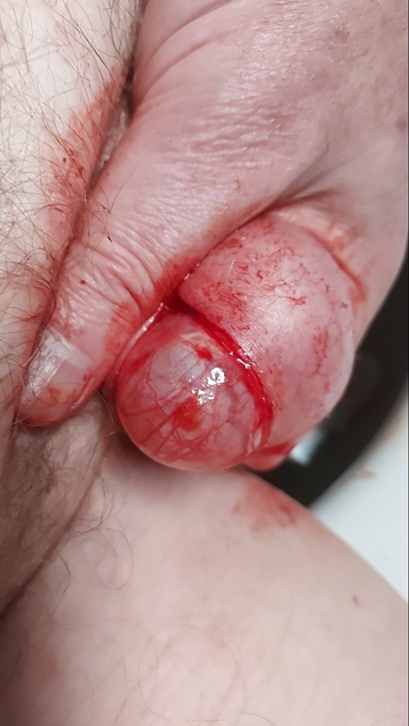 brumeato / scrotum cut open