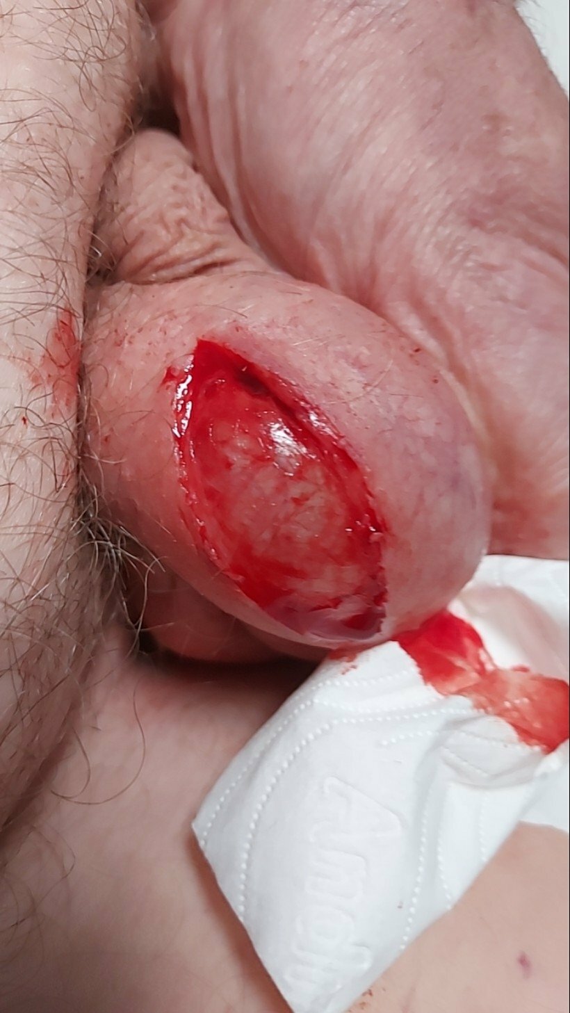 brumeato / scrotum cut open