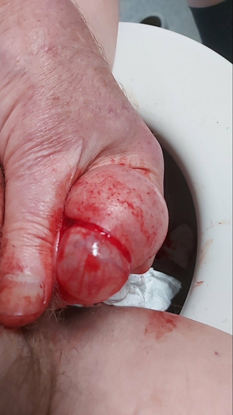 brumeato / scrotum cut open