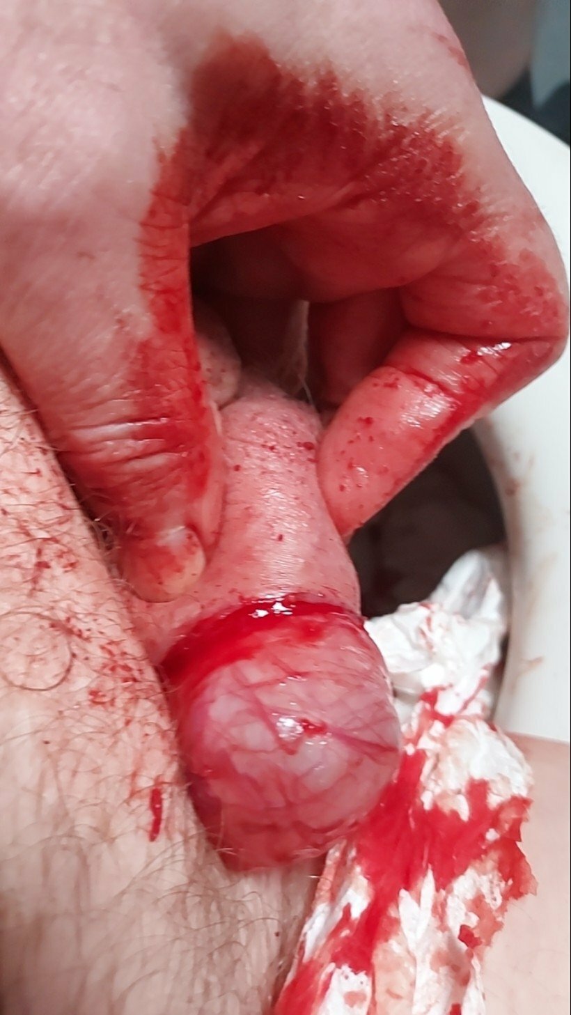 brumeato / scrotum cut open