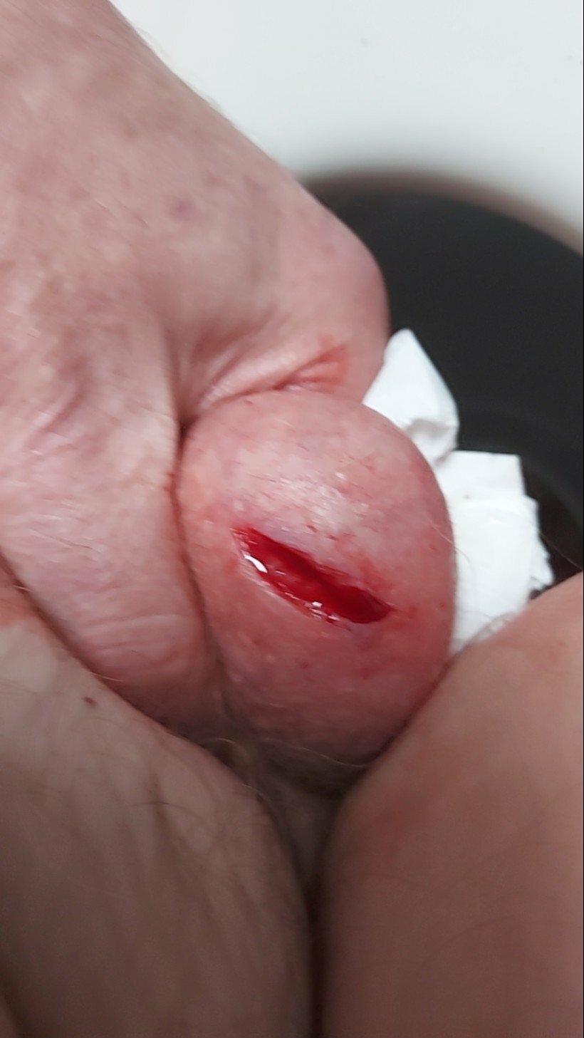 brumeato / scrotum cut open