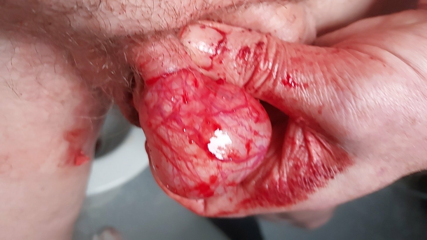 brumeato / scrotum cut open