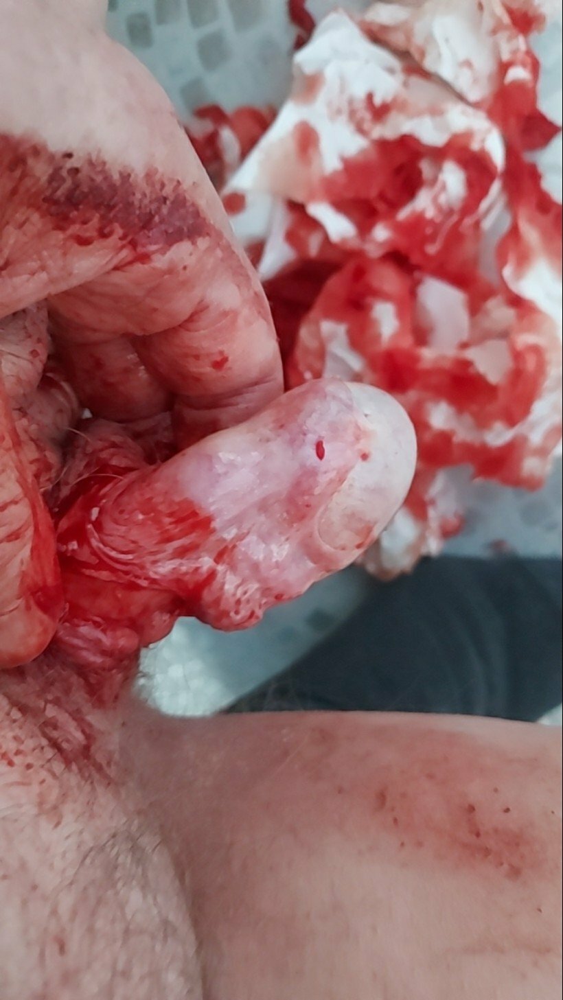 brumeato / scrotum cut open
