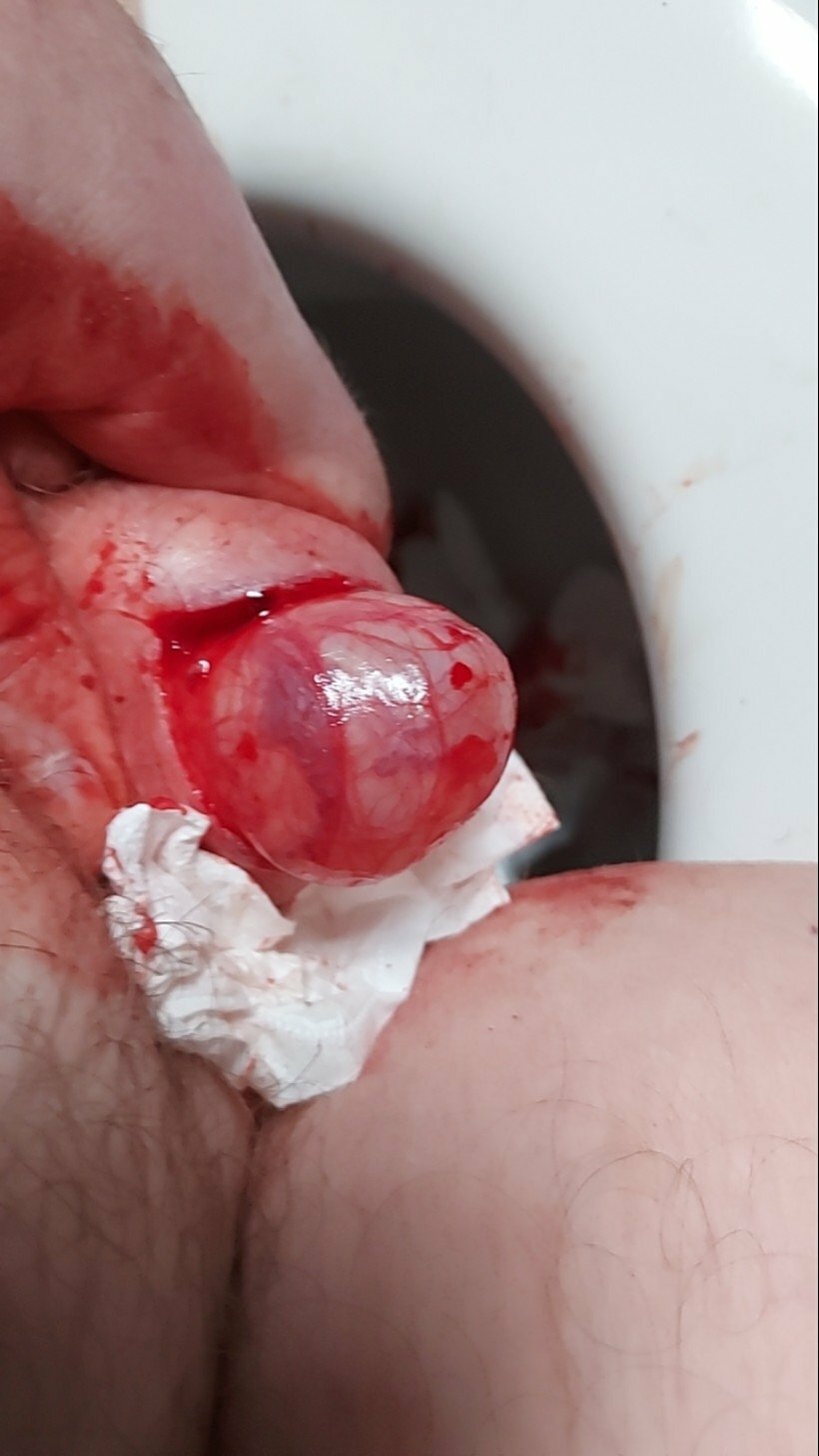 brumeato / scrotum cut open
