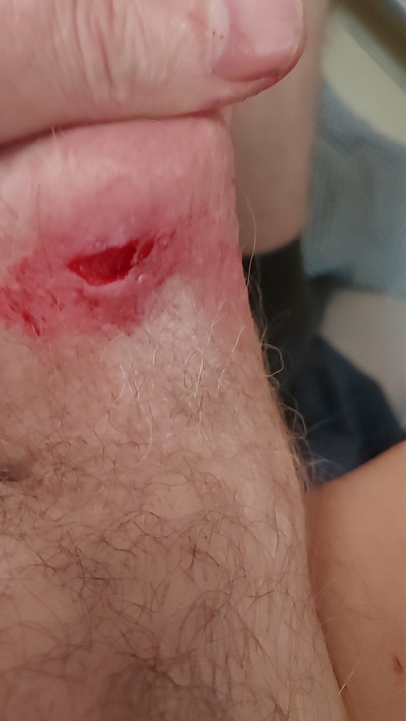 brumeato / scrotum cut open