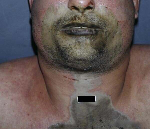 Drinking Sulfuric Acid