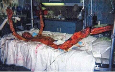 Hisashi Ouchi: the Tukaimura accident aftermath
