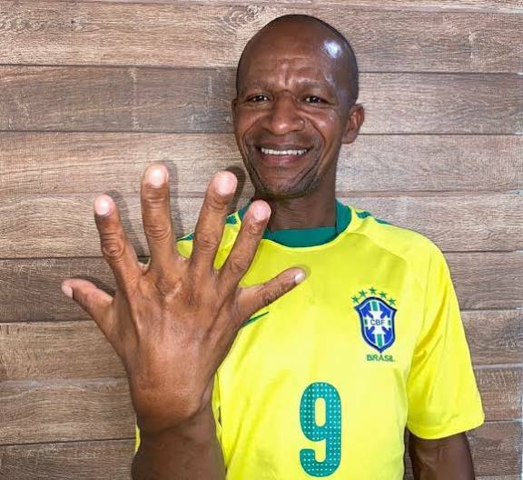 homem com 6 dedos em cada mão