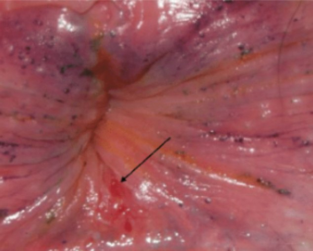 anal injury in a girl