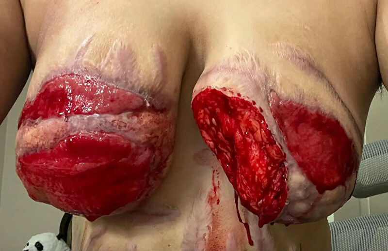 Transgender Body Dysmorphic Disorder