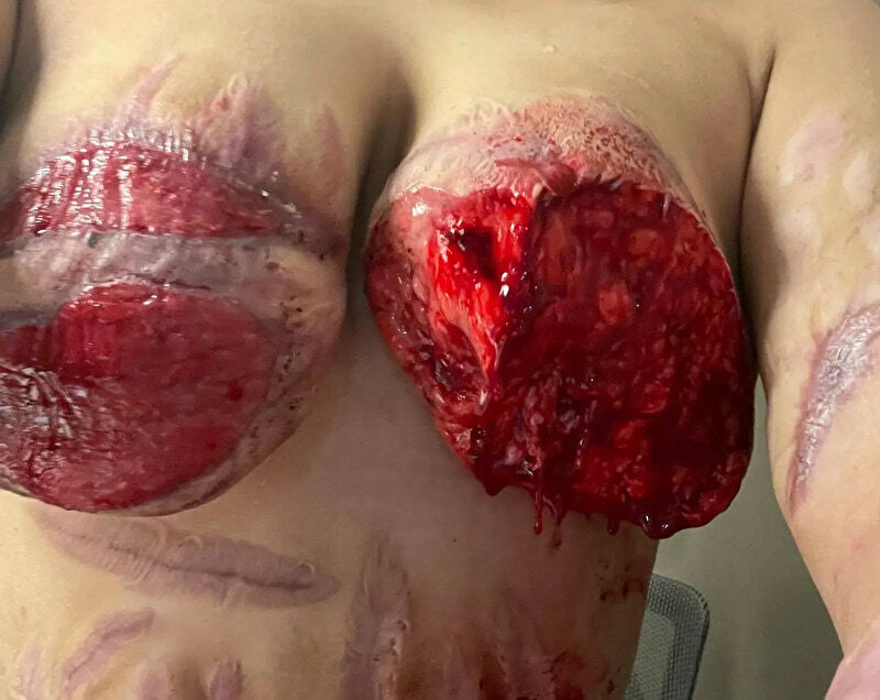 Transgender Body Dysmorphic Disorder