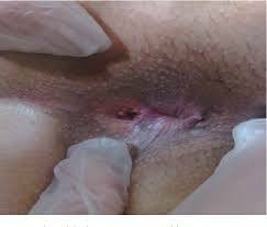 MIX: Duplicated anuses