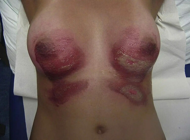 burnt by her own stomach acid