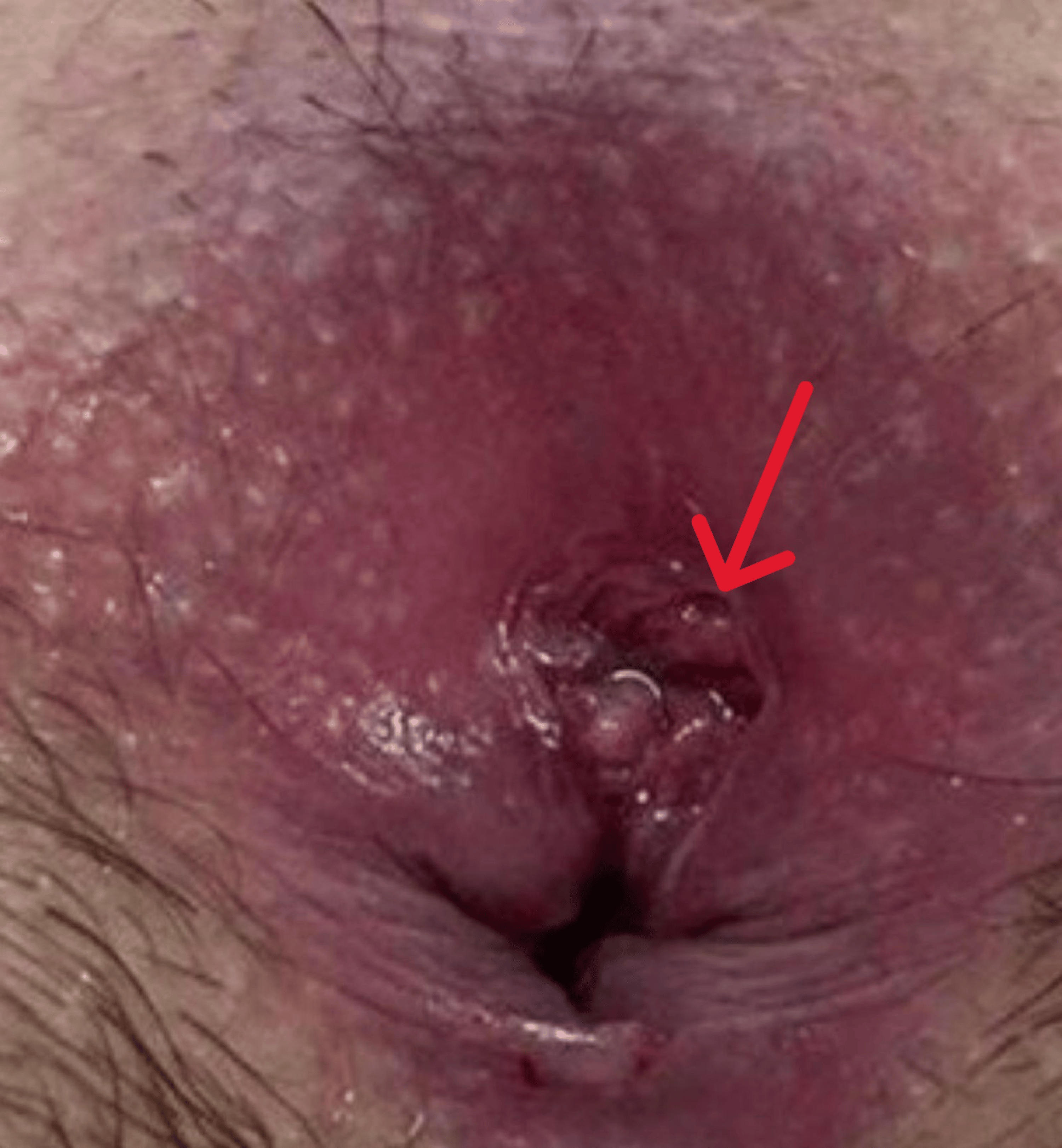 MIX: Duplicated anuses