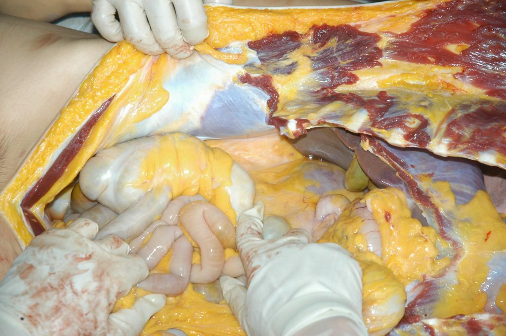 autopsy of a slaughtered woman