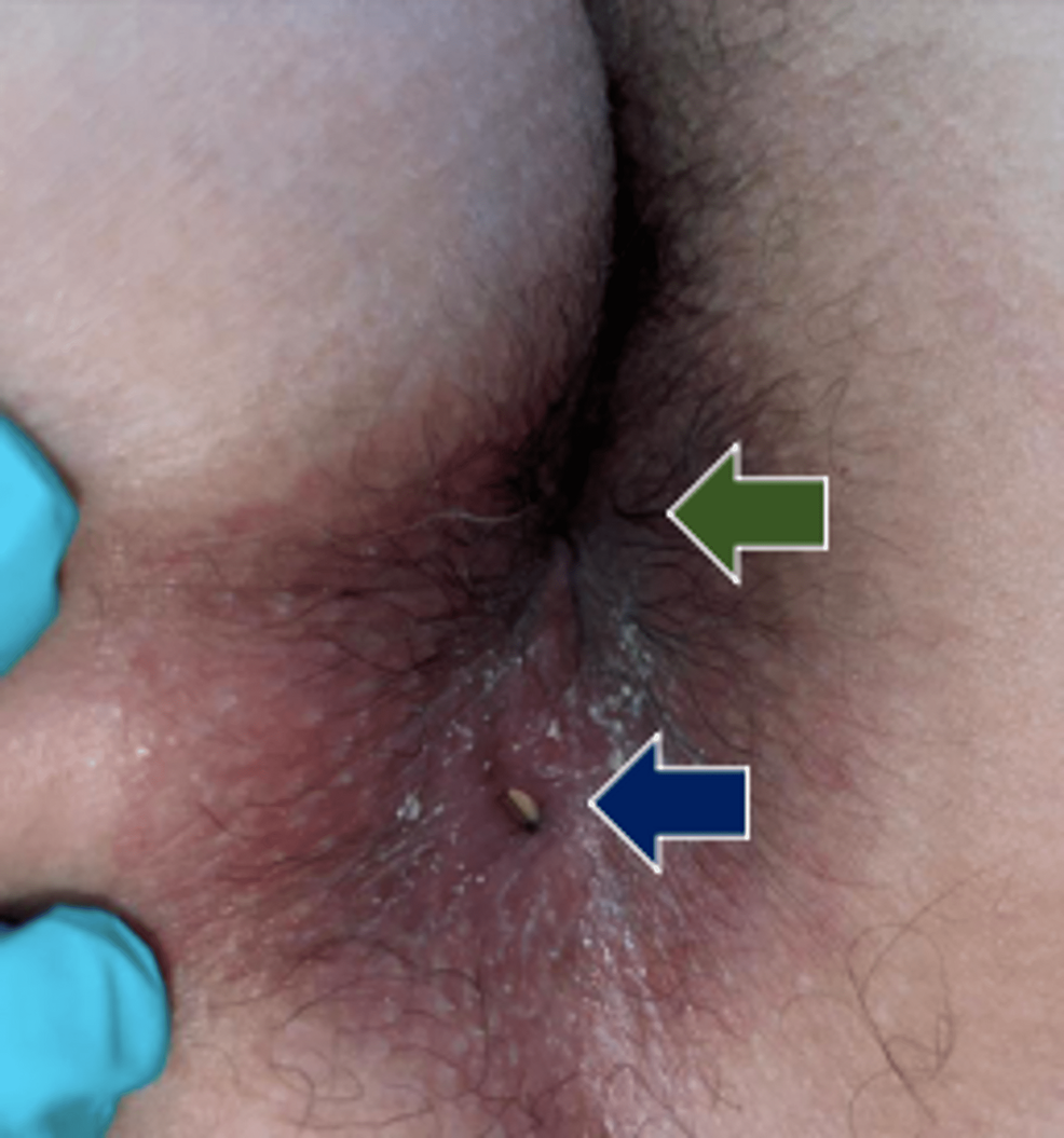 MIX: Duplicated anuses