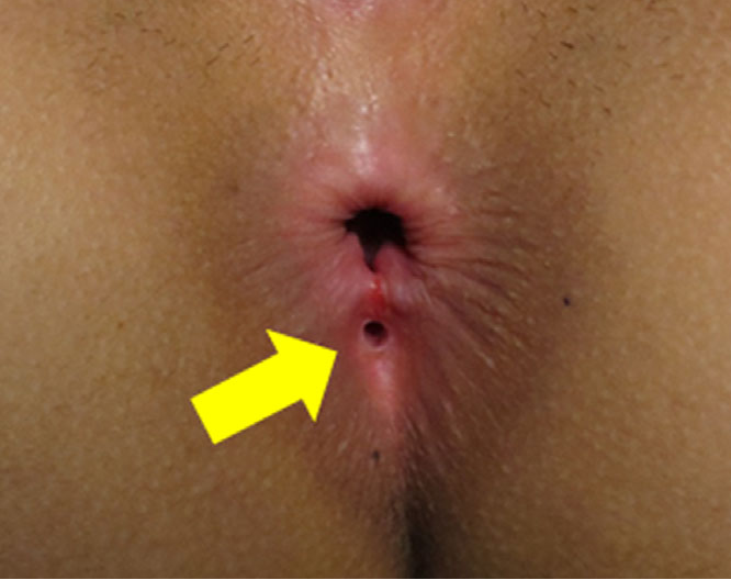 MIX: Duplicated anuses