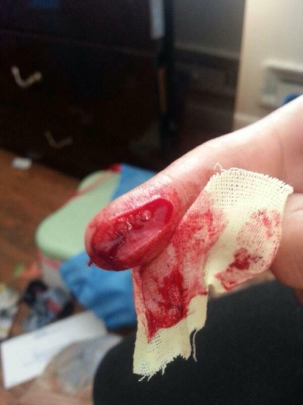 cut on finger