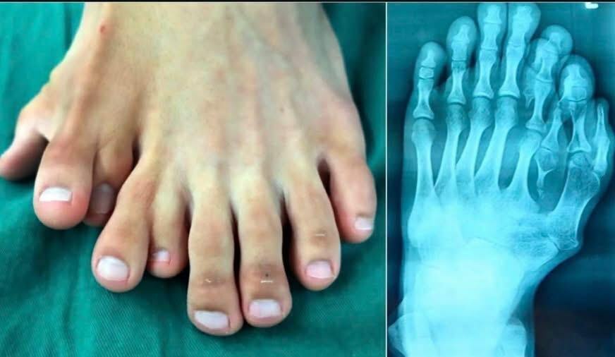 foot with many toes