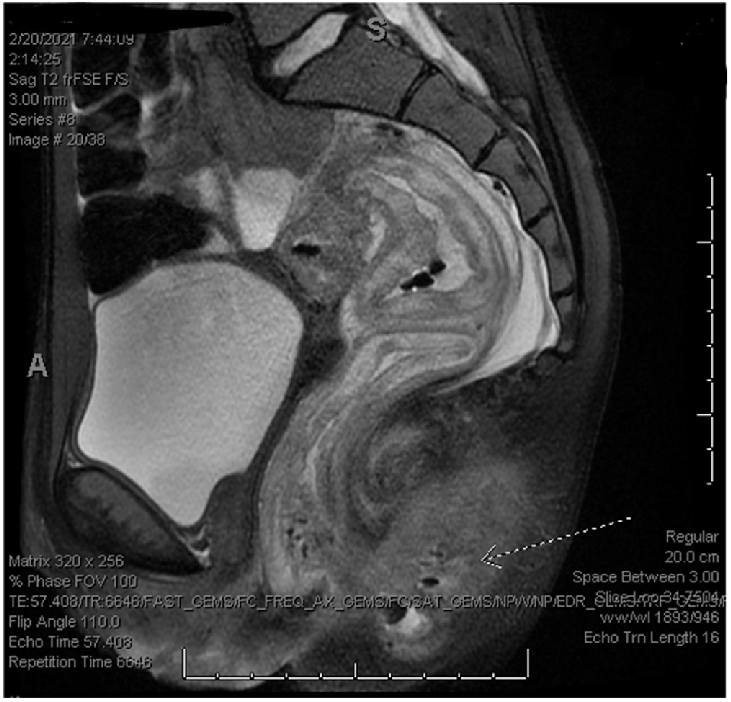 necrotic lesion surrounding butthole