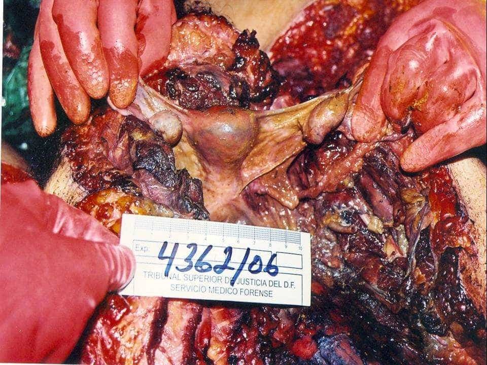 Her attacker was a cannibal