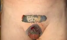 Man Cut's Off His Infected Penis