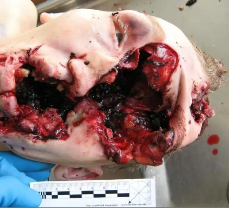 Suicide with shotgun