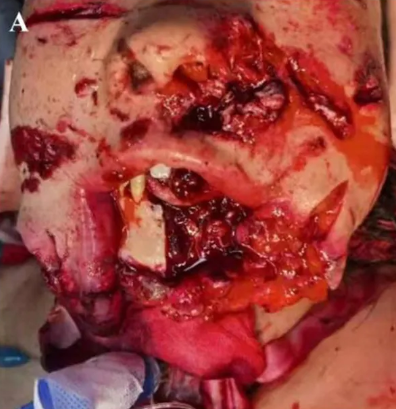 Injury to the jaw and face caused by a heavy object.