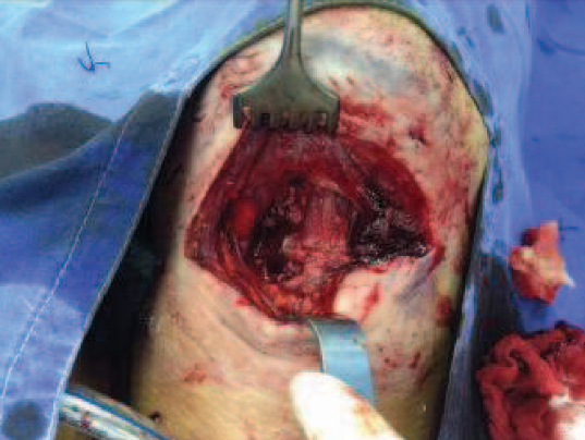 Complex cervical trauma.