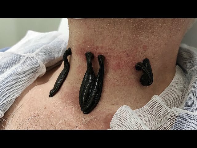 leeches