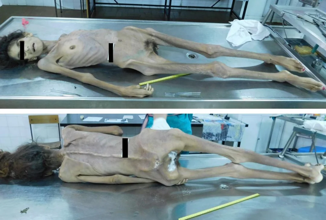 Sudden but not unexpected death in anorexia nervosa.