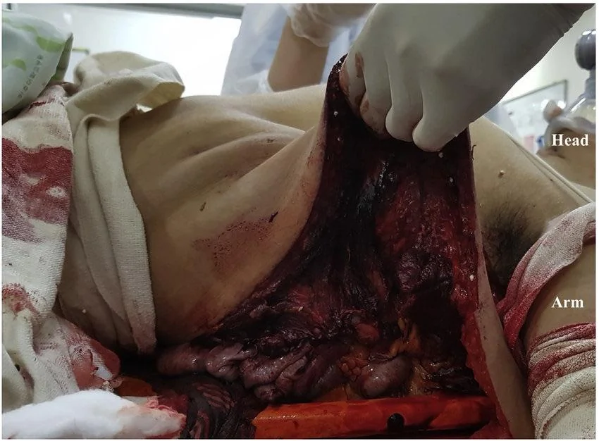 Patient had crush injury to the left side of his chest with associated bowel herniation.