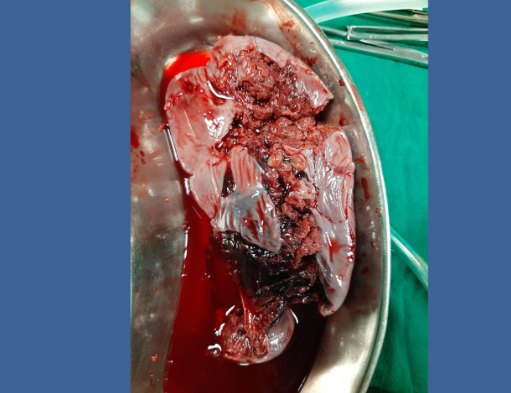 Shattered spleen! Ouch.