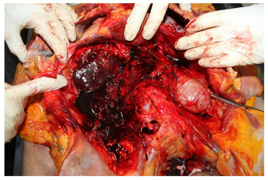 Abdominal trauma, Vertebral fractures.