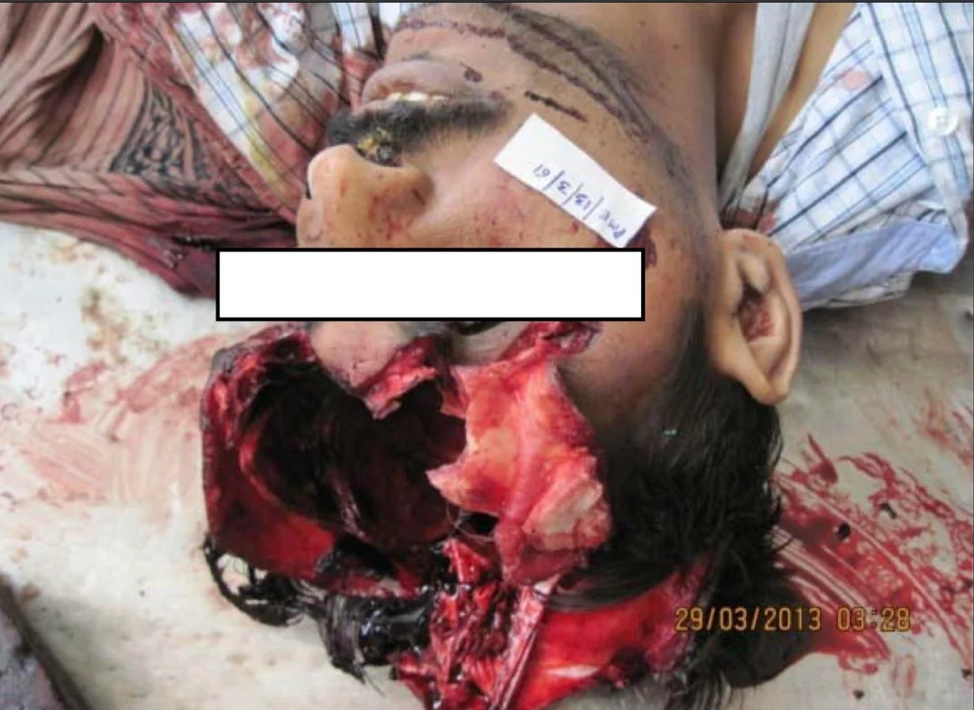 The Kronlein shot (evisceration of the brain)