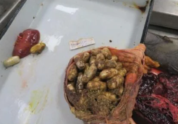 Afghan body packer after death in an Indian motel