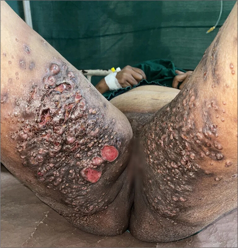 HIV Lady
