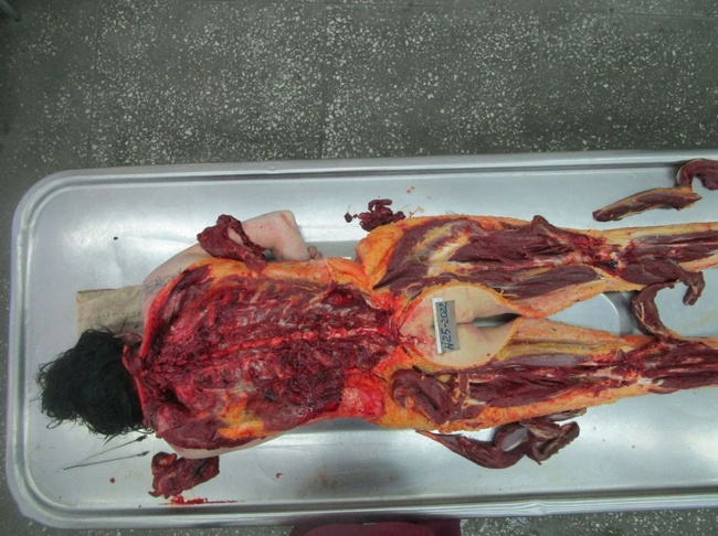 The Beautiful Autopsy