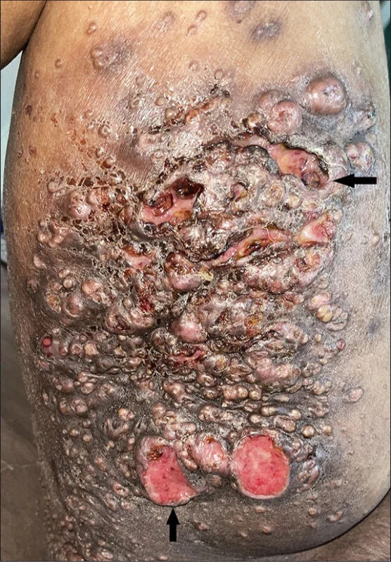 HIV Lady