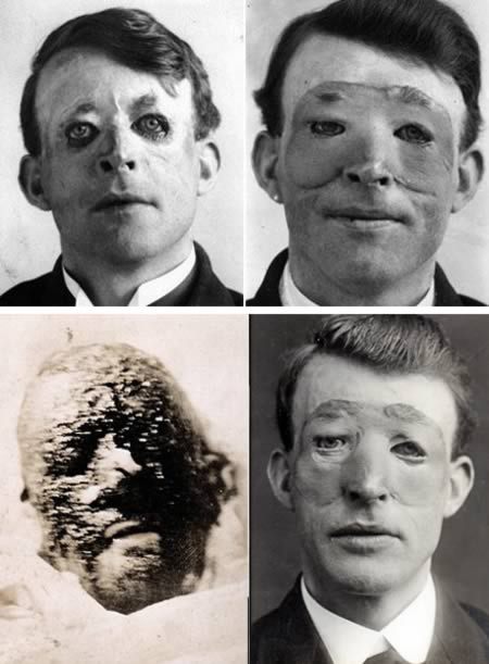 World's First Plastic Surgeries