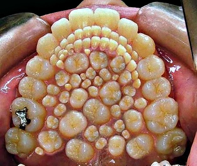 Hyperdontia: A Few Examples