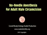 No-Needle Anesthesia for Adult Male Circumcision