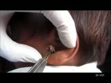 Ear maggots extraction