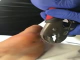 Large Fishing Hook Being Removed From A Men's Foot.