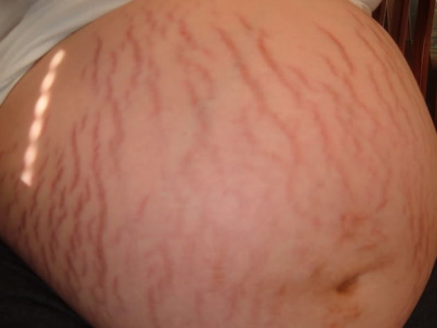 Stretch marks are the devils map