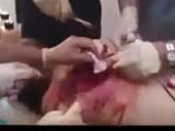 Man With A Huge Hole In His Back Screams As It's Stitched Up